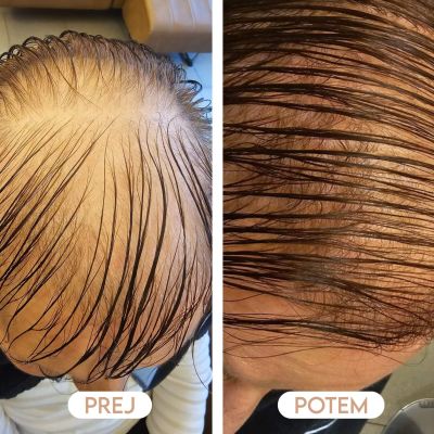 Izpadanje las rezultati po tretmaju