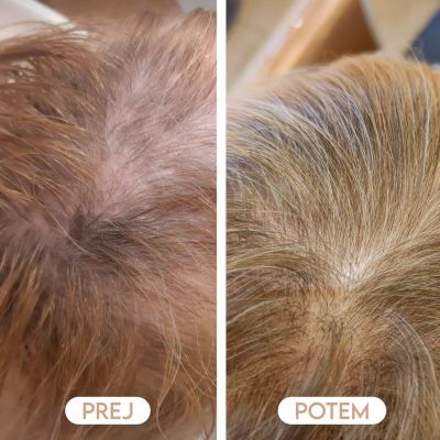 Izpadanje las rezultati